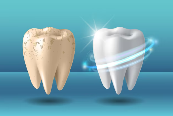 Teeth Bleaching