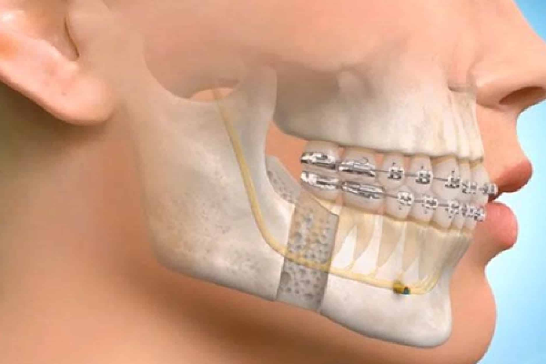 Maxillofacial Prosthesis